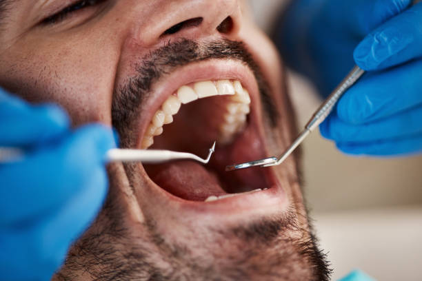 Best Emergency Wisdom Teeth Removal in Clifton Gardens, NY